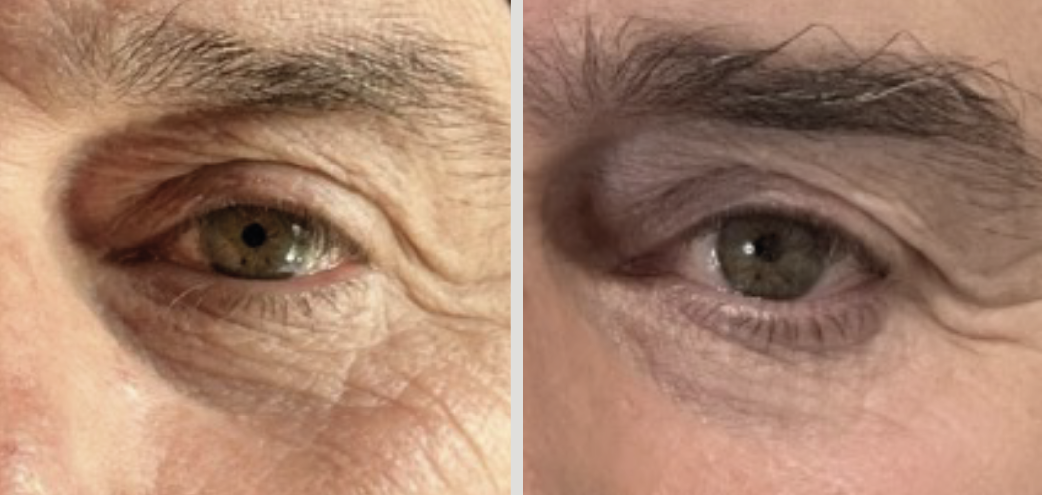 Donkere kringen behandelen