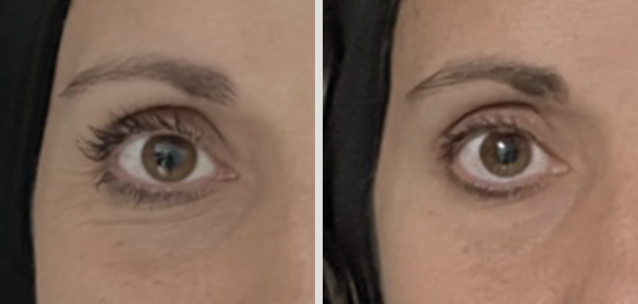 Donkere kringen behandelen