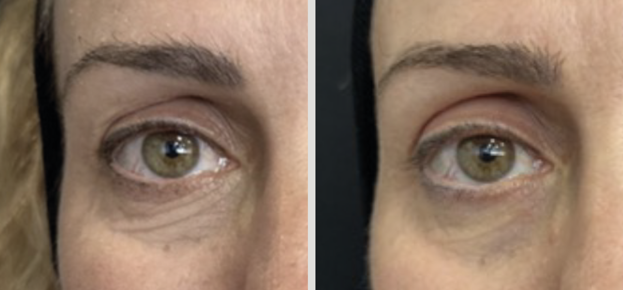 Donkere kringen behandelen