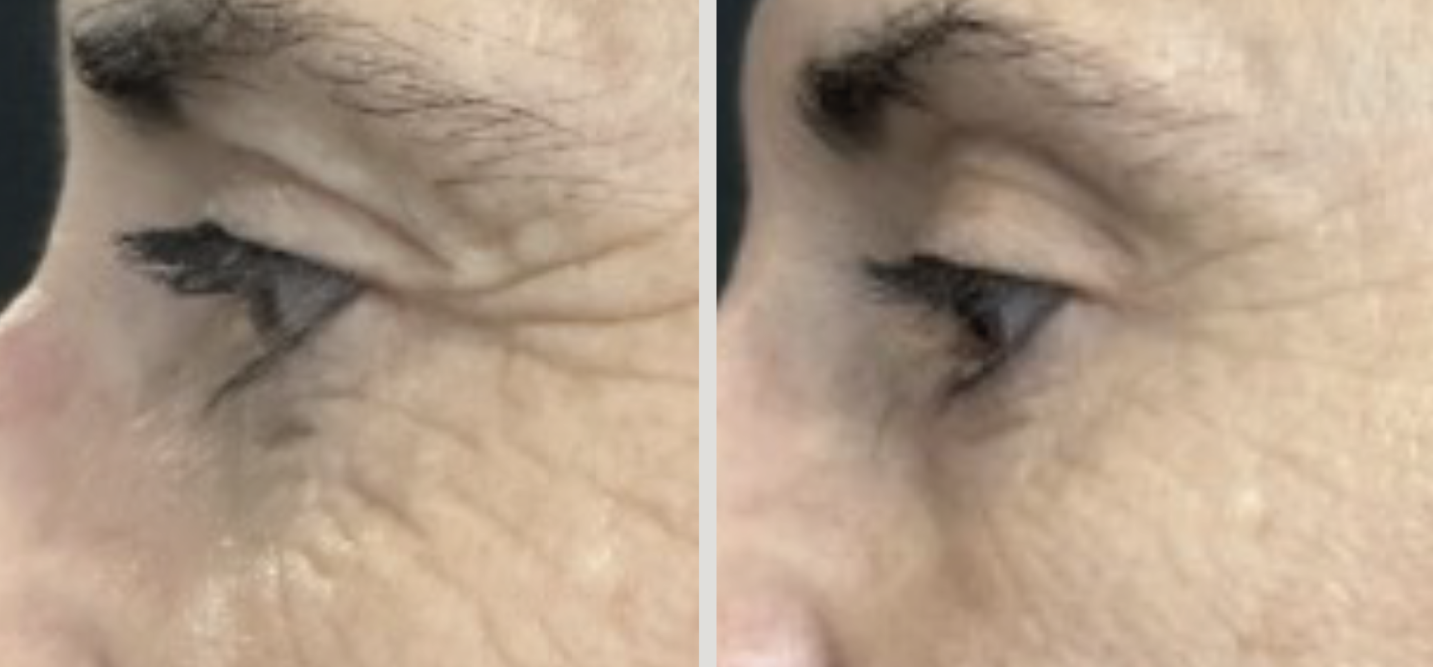 Donkere kringen behandelen