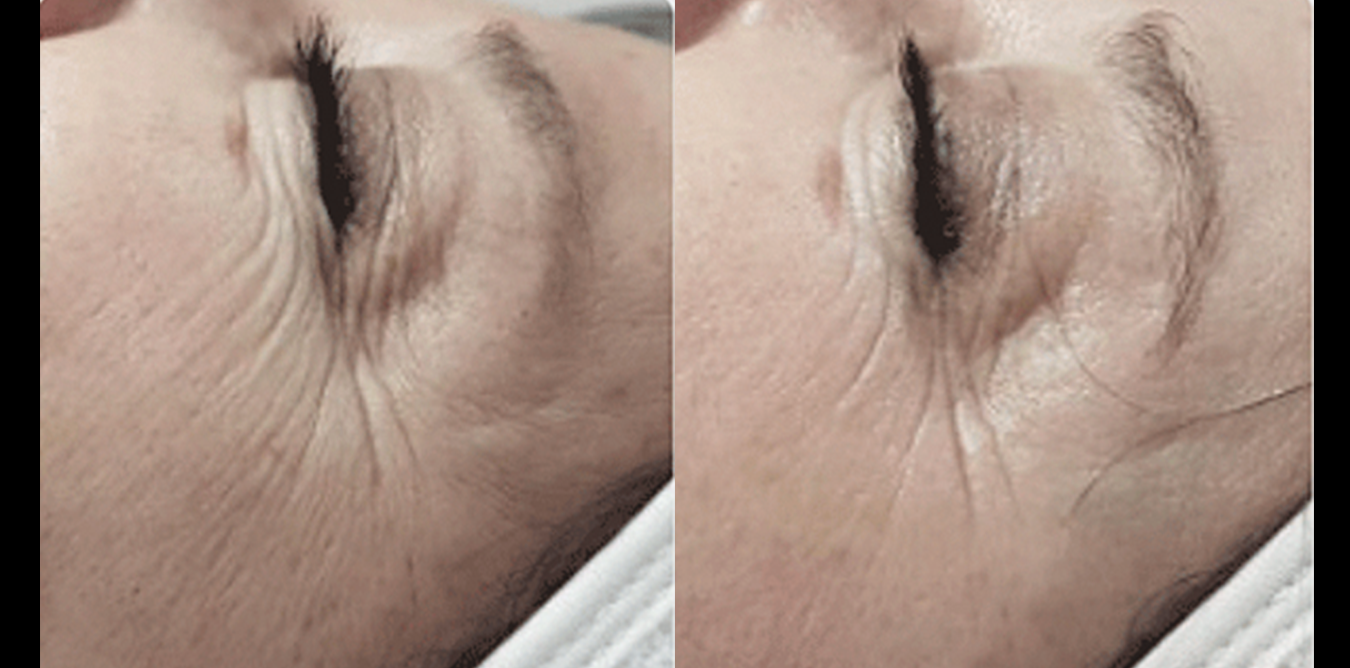 1Need Pro Microneedling Pen