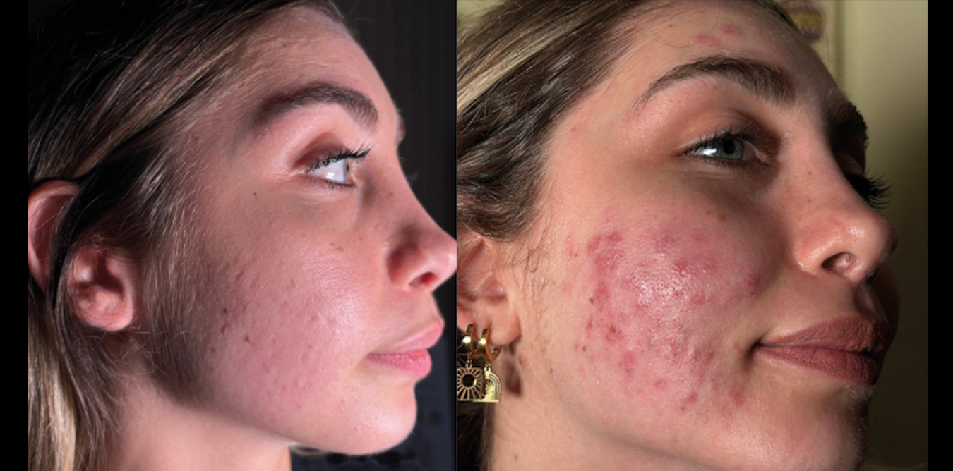 1Need Pro Microneedling Pen